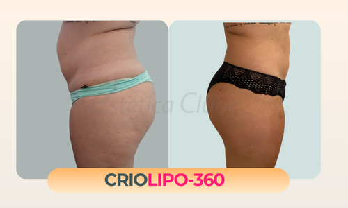 Criolipolise Abdômen e costas